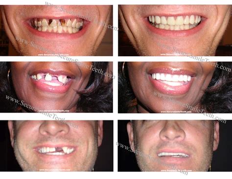 how much are fake white teeth
